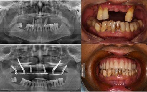 佛山种牙爆料事件最新情况,最新进展与各方回应梳理